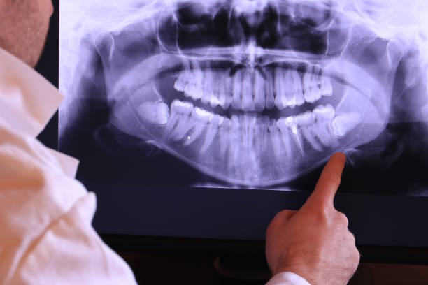 Best Emergency Wisdom Teeth Removal in Central, LA