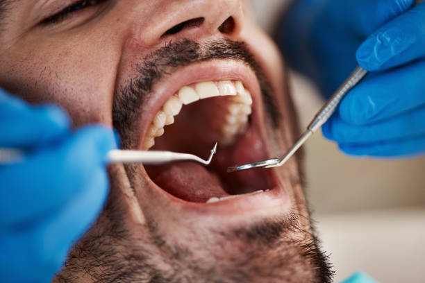 Best Emergency Wisdom Teeth Removal in Central, LA